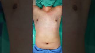 Gynecomastia result | Gynecomastia Surgery cost | #shortvideo #shots #dezireclinicindia