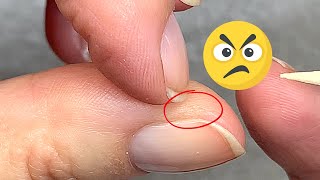 Hard, Annoying Skin Around the Nails?